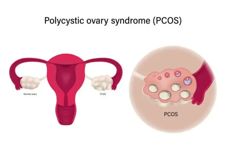 Decoding PCOS: Unraveling the Basics of Diagnosis, Symptoms, and Treatment